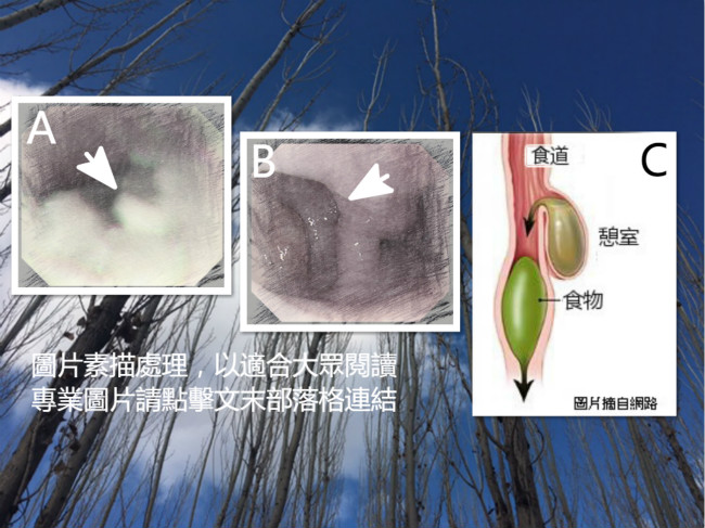 食道憩室網站S